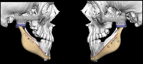 Fig 5. Ung gutt med Treatcher Collin lignende syndrom med manglende kinnben og liten deform underkjeve, tidligere operert. Fig viser Biomet «custom made» proteser i produksjon og som senere er implantert bilateralt.